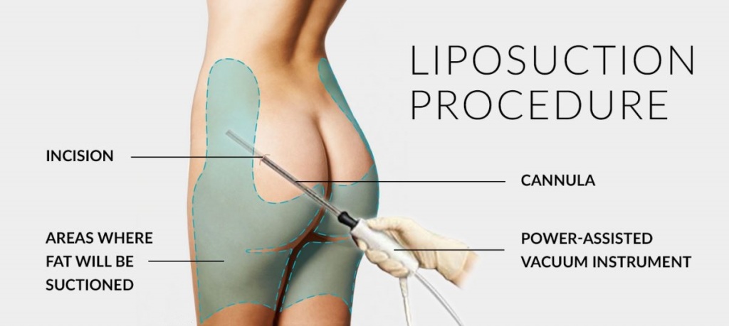 https://www.drvivekkumar.com/images-drvivek/blog/liposuction-surgery-delhi.jpg